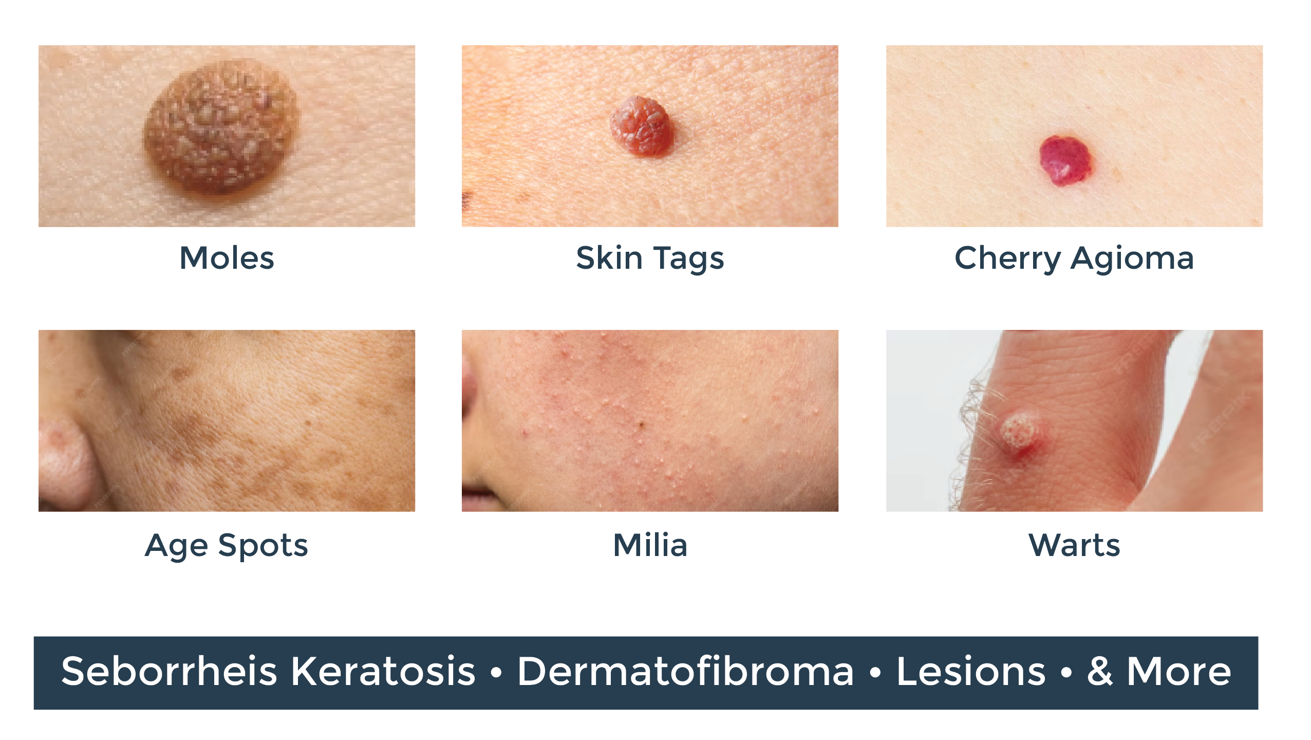 Mole and Skin tag removal