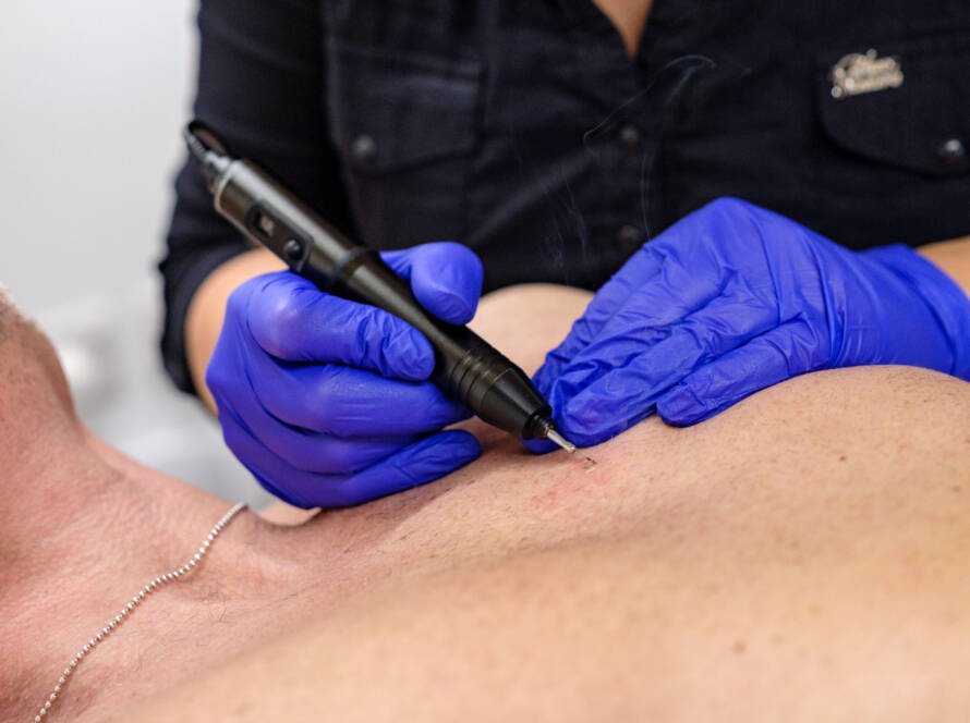 Blemish removal in surrey
