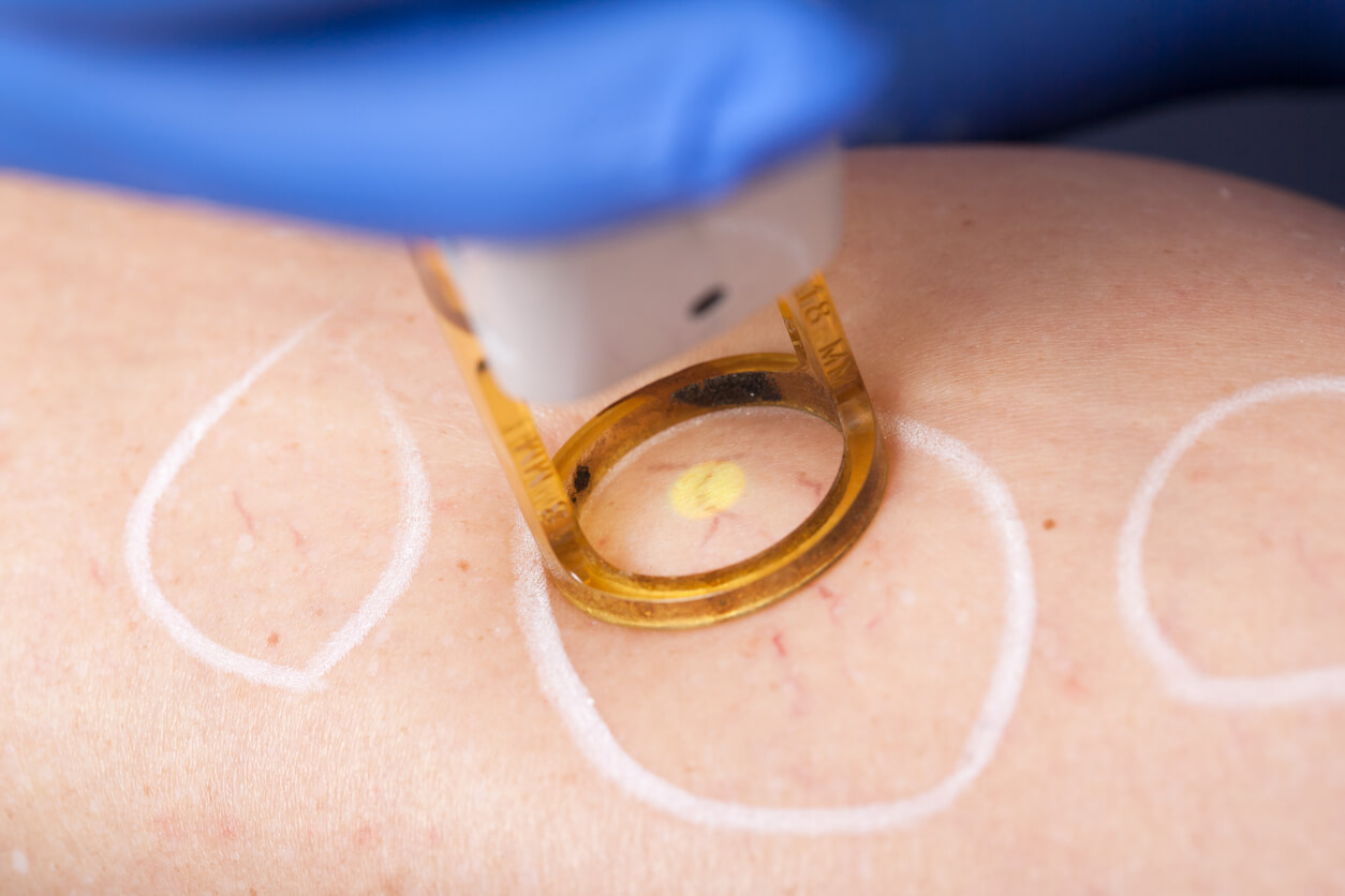 Thread Vein Removal: Safe and Effective Treatments for Clearer Skin - FBS