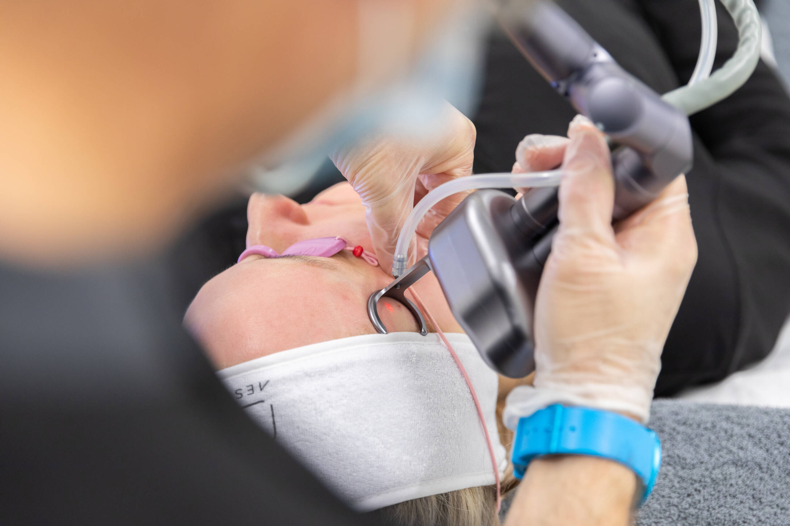 Advanced CO₂ Laser – Advanced Skin Rejuvenation