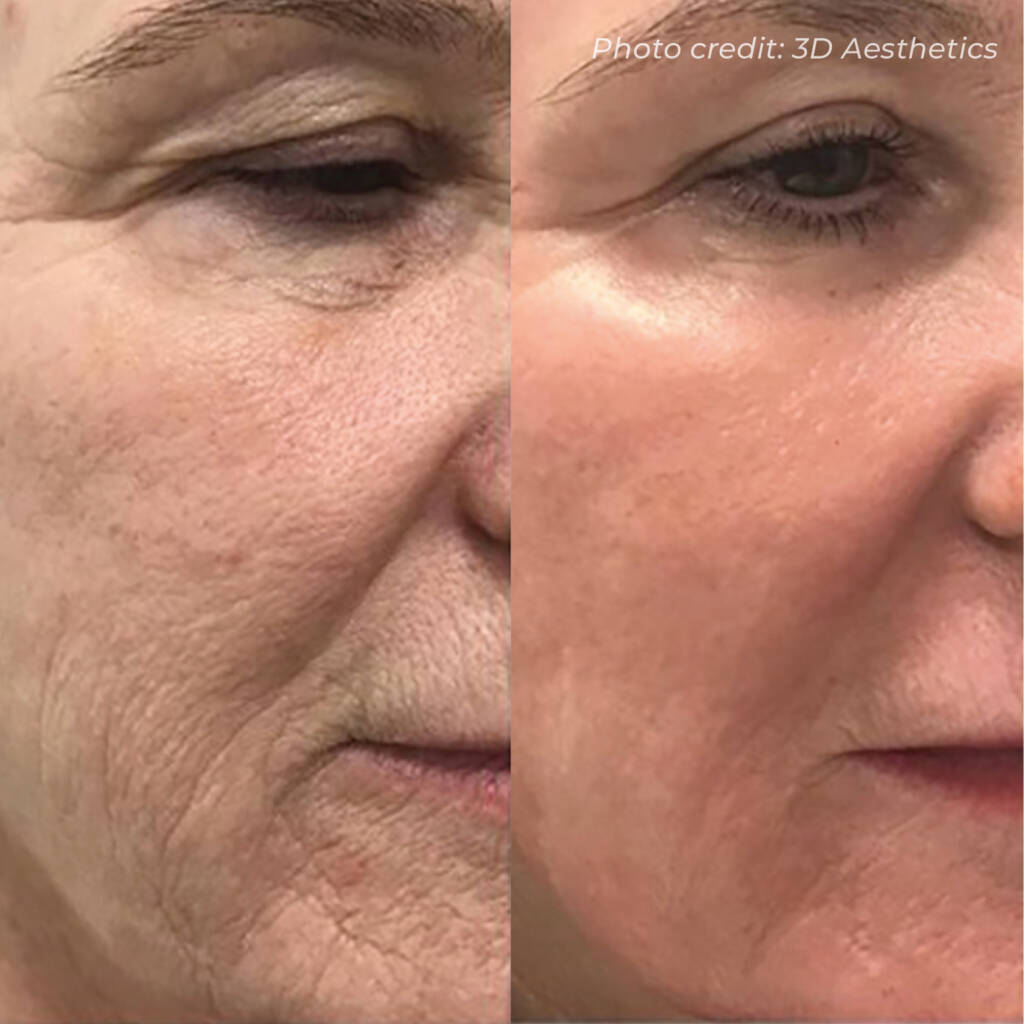C02 Before and after fine lines and wrinkles