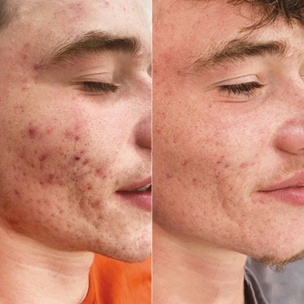 c02 before and after acne scarring