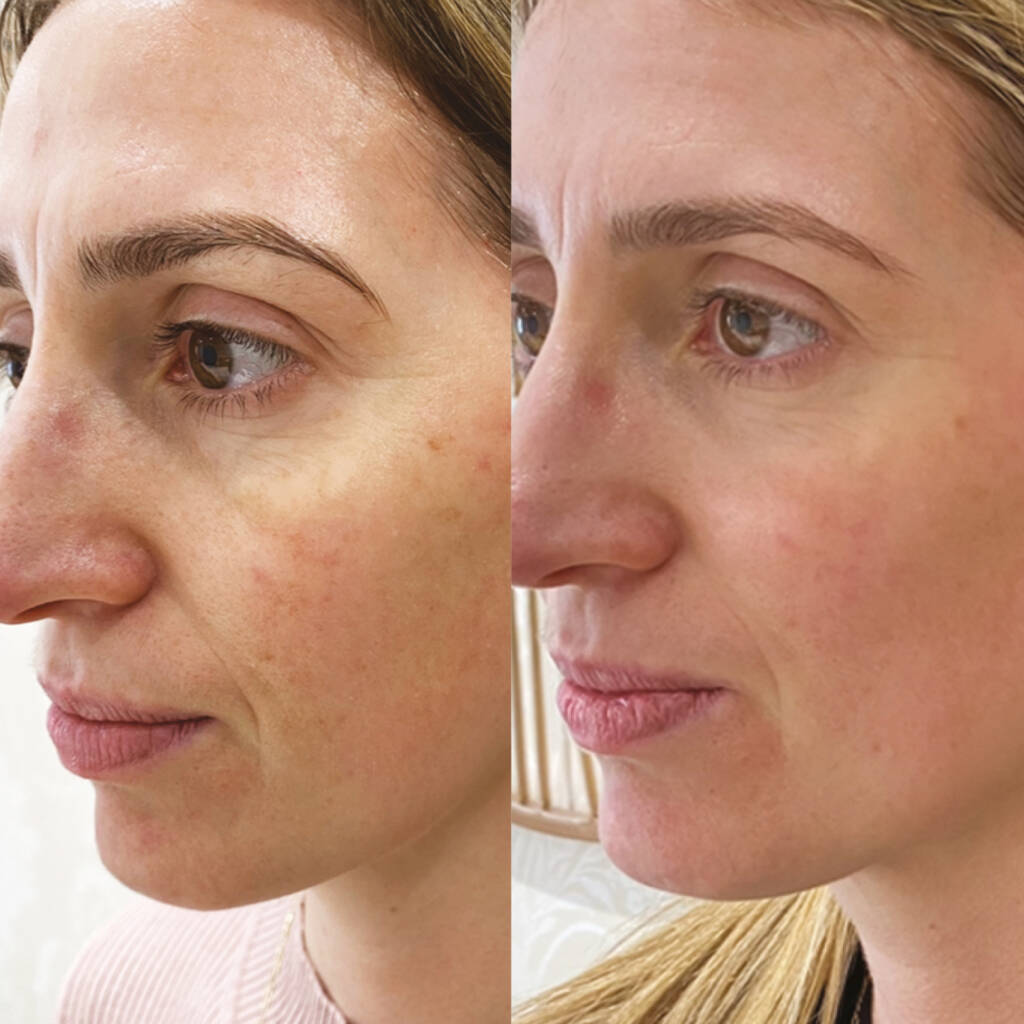 c02 before and after fine lines and wrinkles