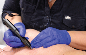 Blemish removal - warts, skin tags