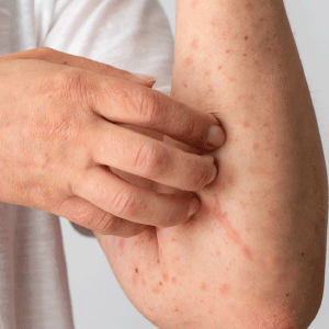 Psoriasis and Nail fungus