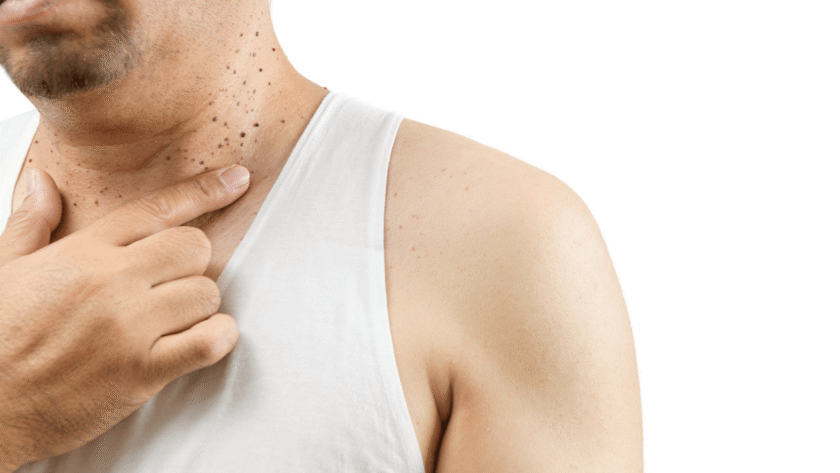 Why Choose a Medical Aesthetics Clinic For Skin Tag Removal