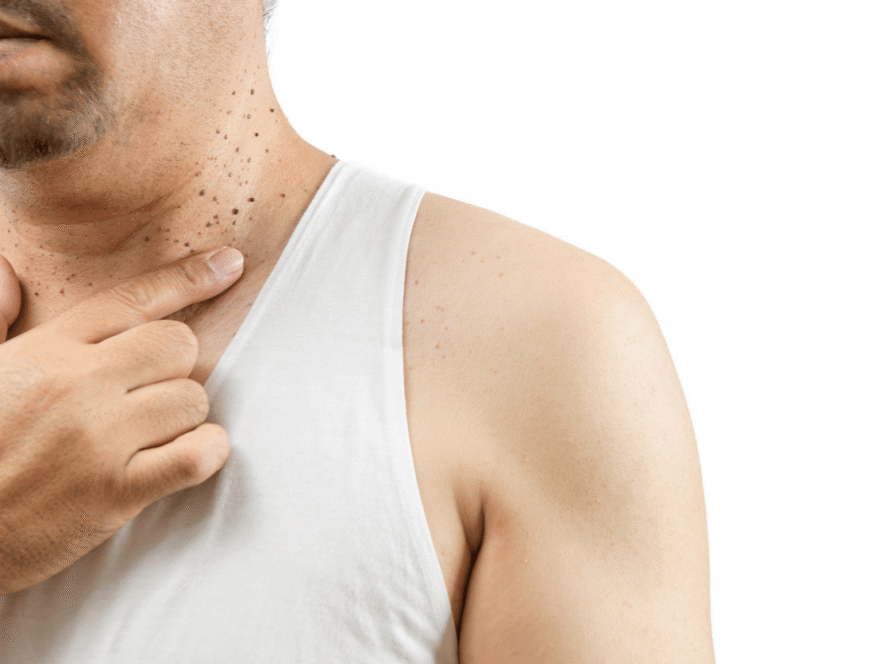 Why Choose a Medical Aesthetics Clinic For Skin Tag Removal