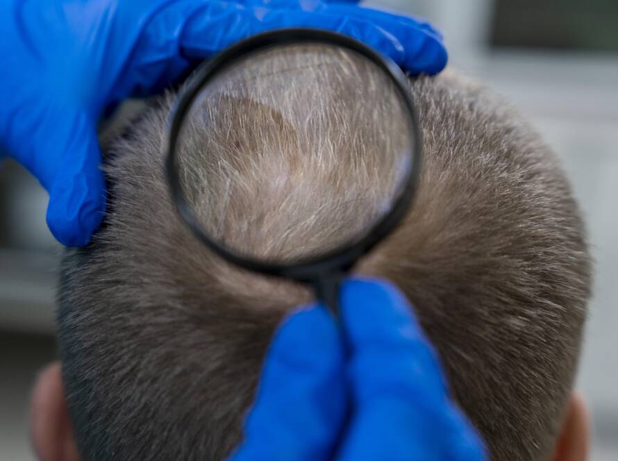 Hair Thinning treatment