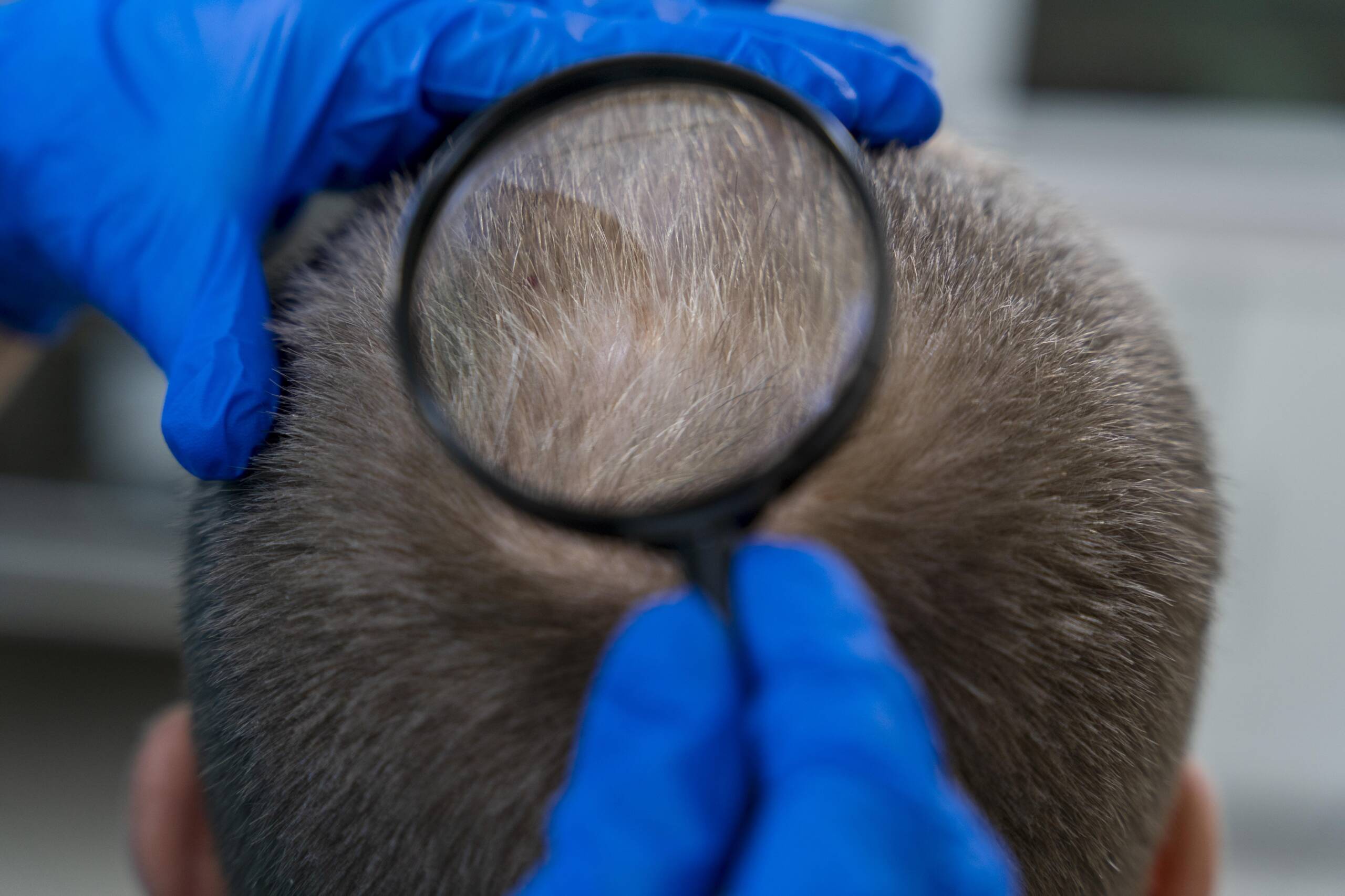 Hair thinning treatment for men and women
