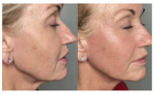Morphue8 skin tightening treatment in Egham