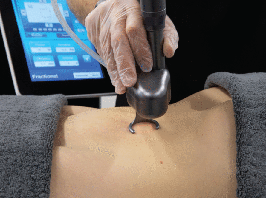 C02 laser for weight loss