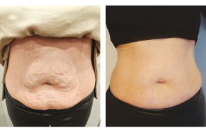 Body Contouring Before and after