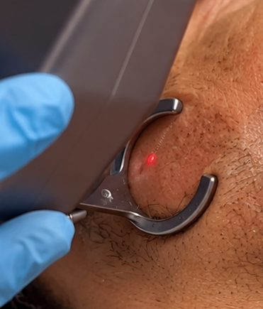 C02 Laser for men's face